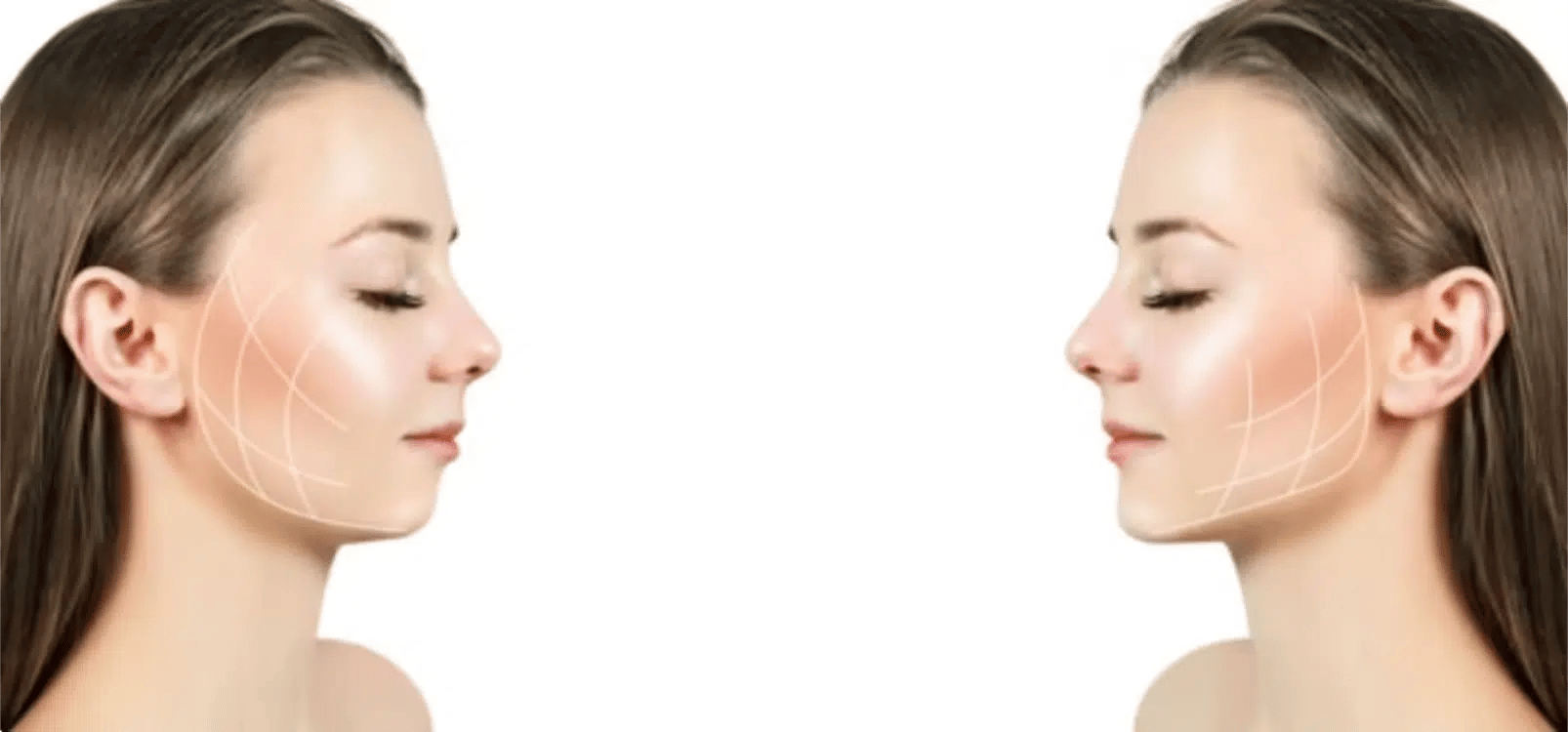 Jawline Filler before and after
