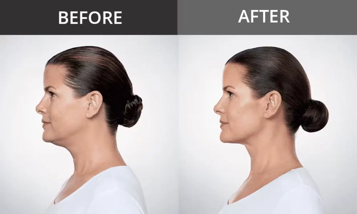 Kybella Double Chin before and after
