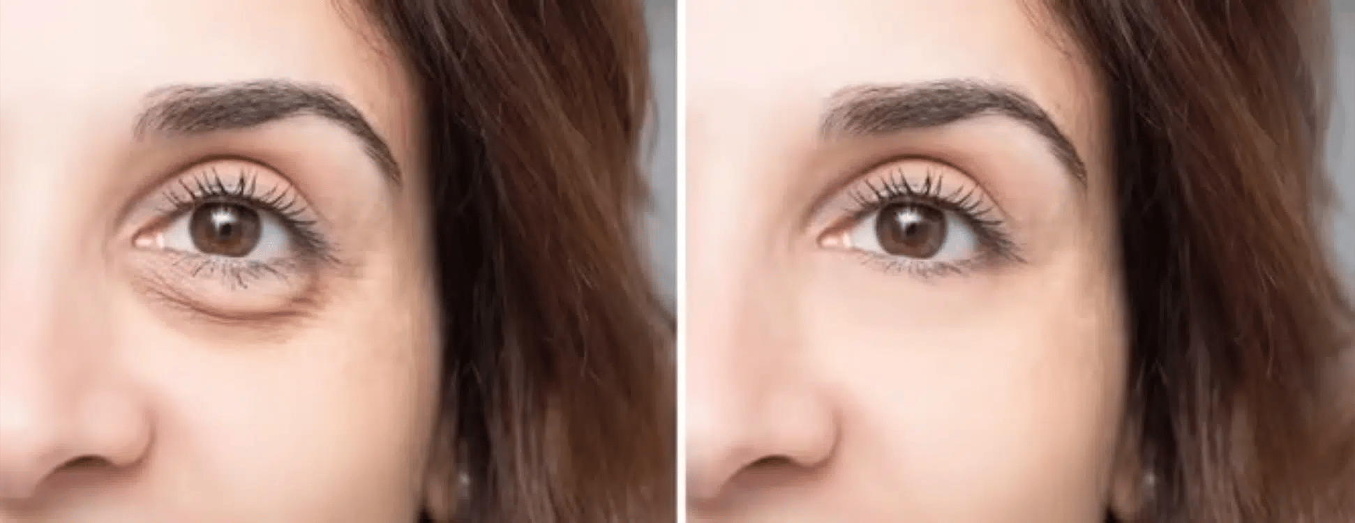 Under Eye Filler before after