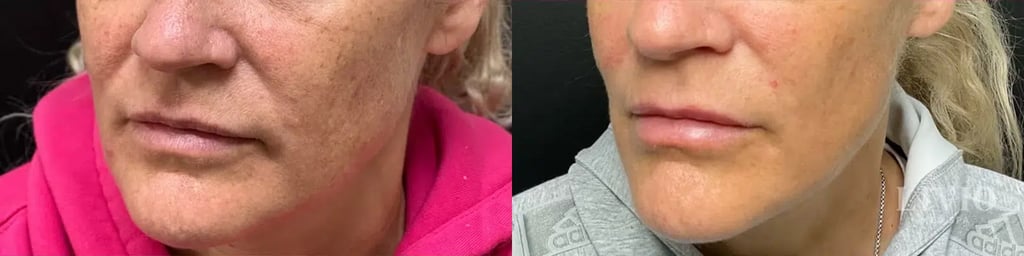 bbl laser before and after photo by livio med spa in cincinnati oh