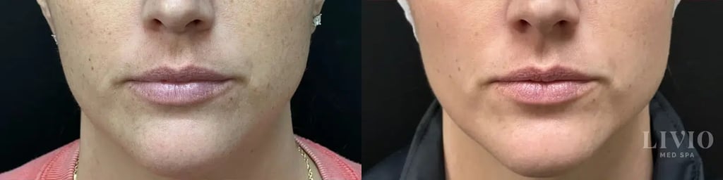 bbl laser before and after photo by livio med spa in cincinnati oh
