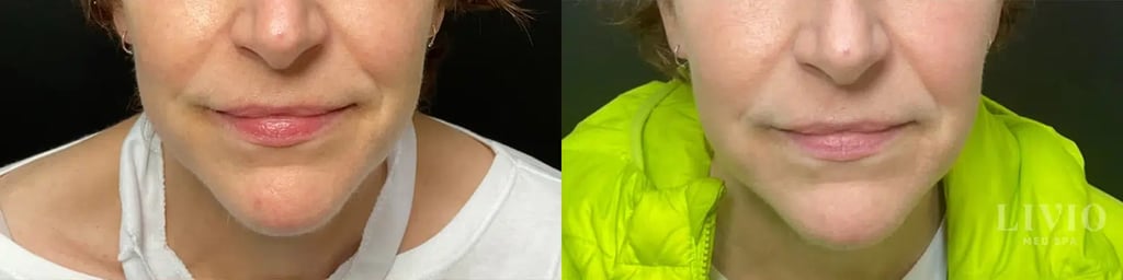 bbl laser before and after photo by livio med spa in cincinnati oh