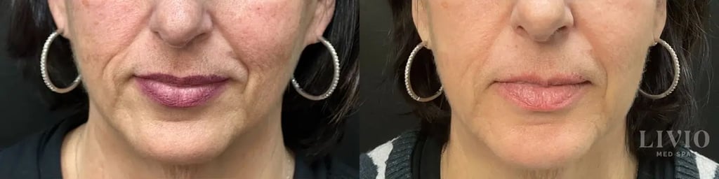 bbl laser before and after photo by livio med spa in cincinnati oh