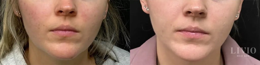 bbl laser before and after photo by livio med spa in cincinnati oh