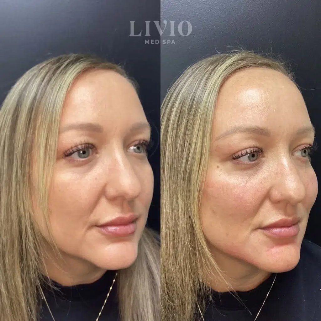 cheek filler before and after photo by livio med spa in cincinnati oh