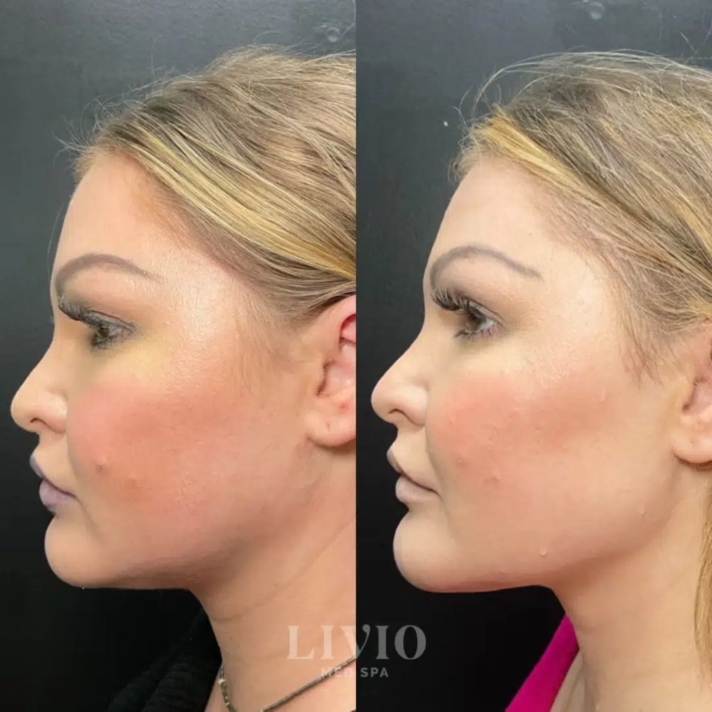 chin filler before and after photo by livio med spa in cincinnati oh