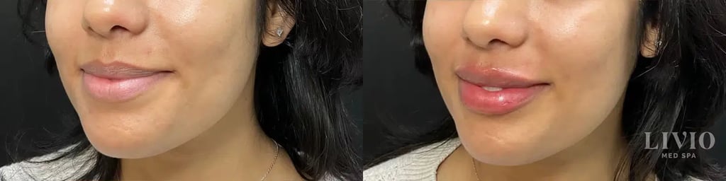 lip filler before and after photo by livio med spa in cincinnati oh