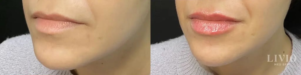 lip filler before and after photo by livio med spa in cincinnati oh