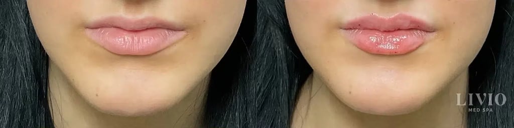 lip filler before and after photo by livio med spa in cincinnati oh