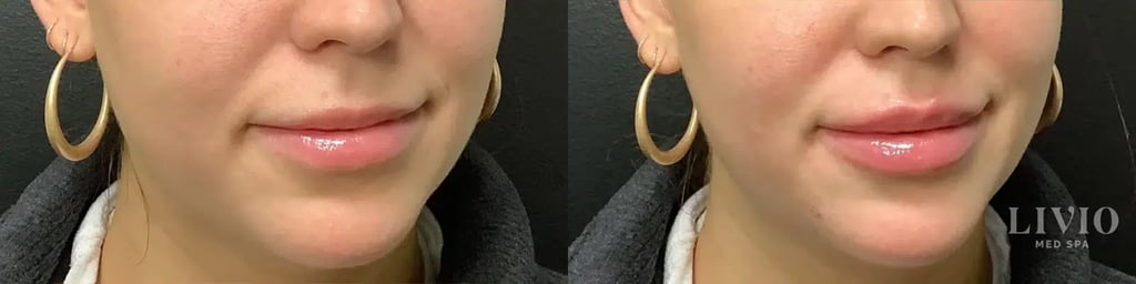 lip filler before and after photo by livio med spa in cincinnati oh