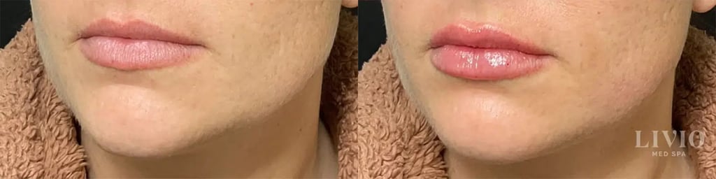lip filler before and after photo by livio med spa in cincinnati oh