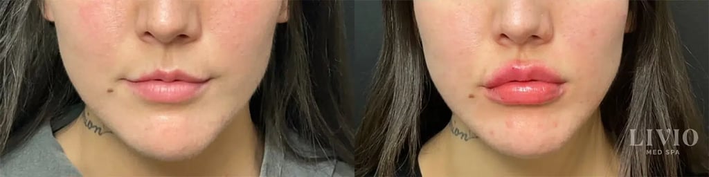 lip filler before and after photo by livio med spa in cincinnati oh