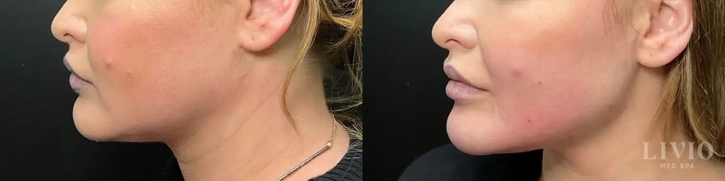 kybella before and after photo by livio med spa in cincinnati oh
